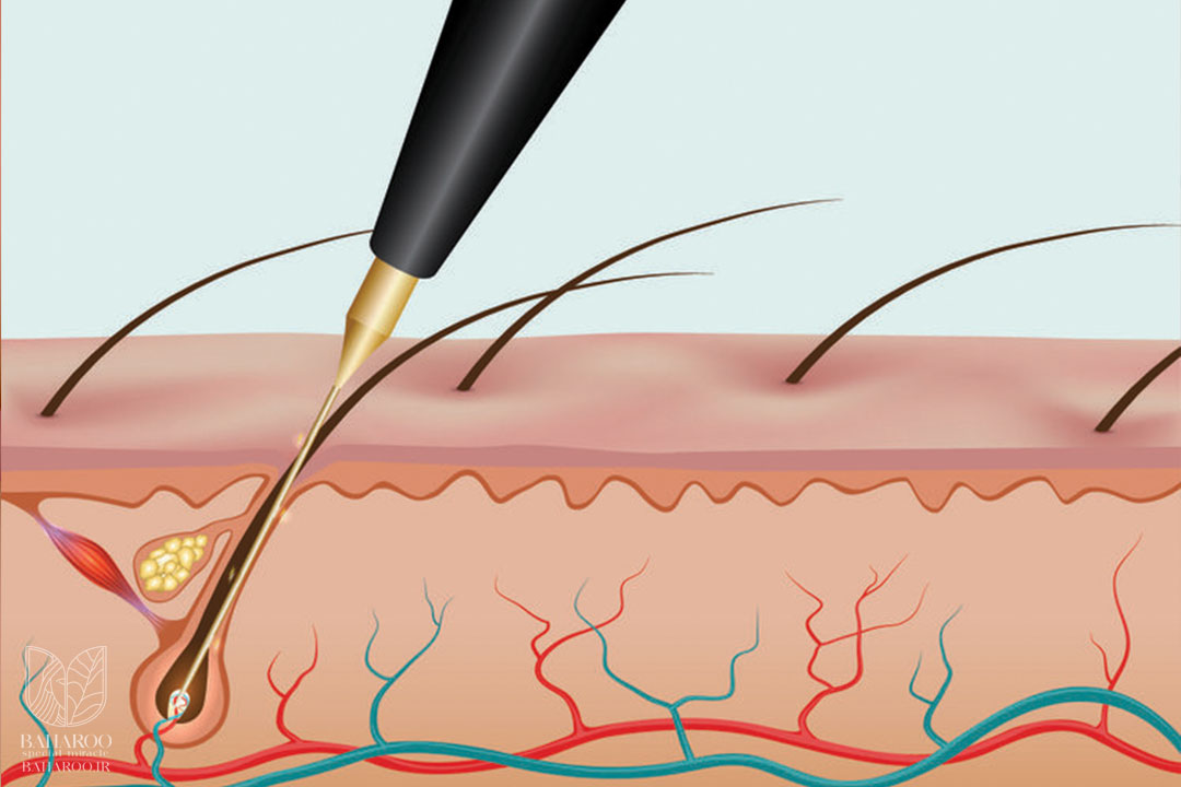 الکترولیز موهای زائد - مرکز زیبایی بهارو